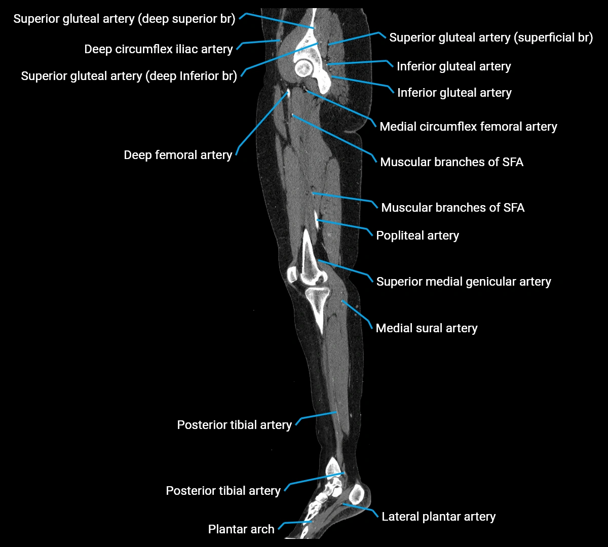 CTA lower limb sagittal cross sectional anatomy labelled image _35 (3).webp